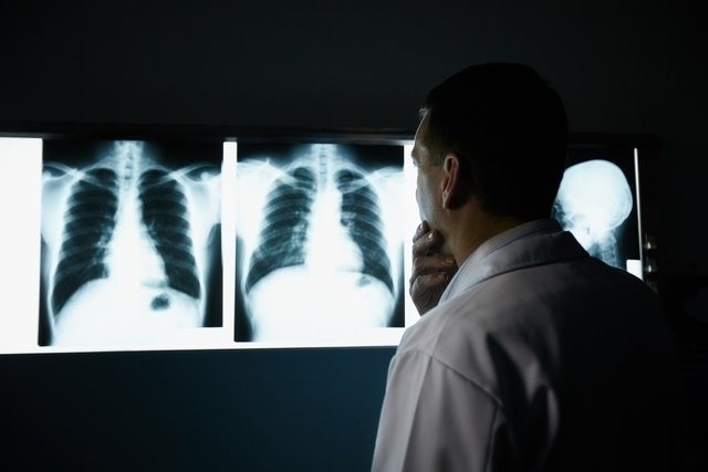 7 pilihan pengobatan kanker paru-paru_0