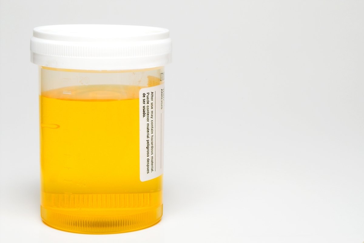 Sel epitel dalam urin: apa itu dan bagaimana memahami pemeriksaannya_0