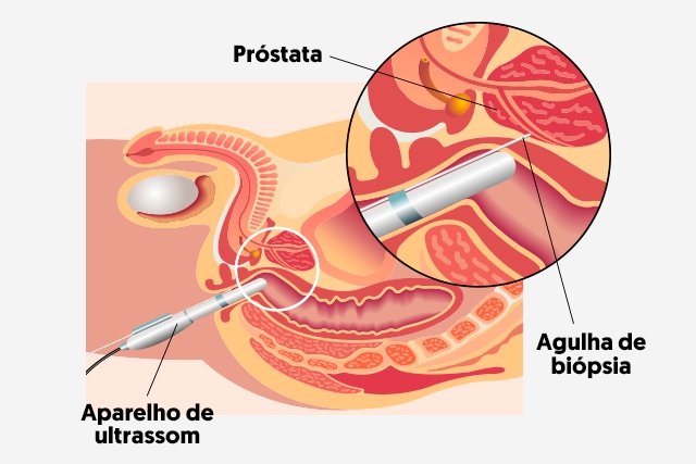Biopsi prostat: kapan melakukannya, persiapan, hasil dan komplikasi_0