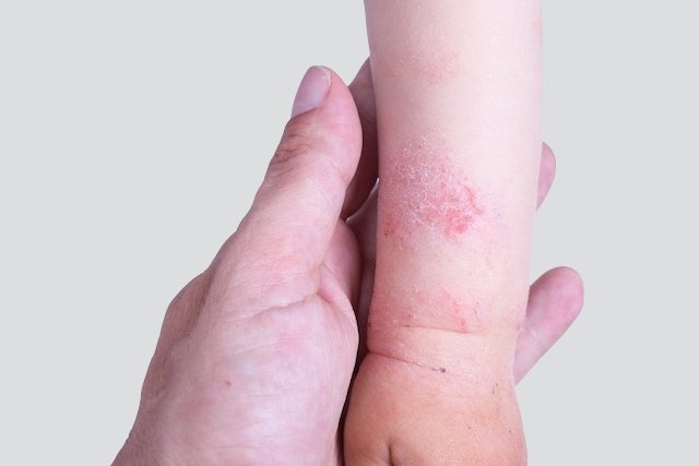 Dermatitis atopik: apa itu, gejala, penyebab dan pengobatan_0