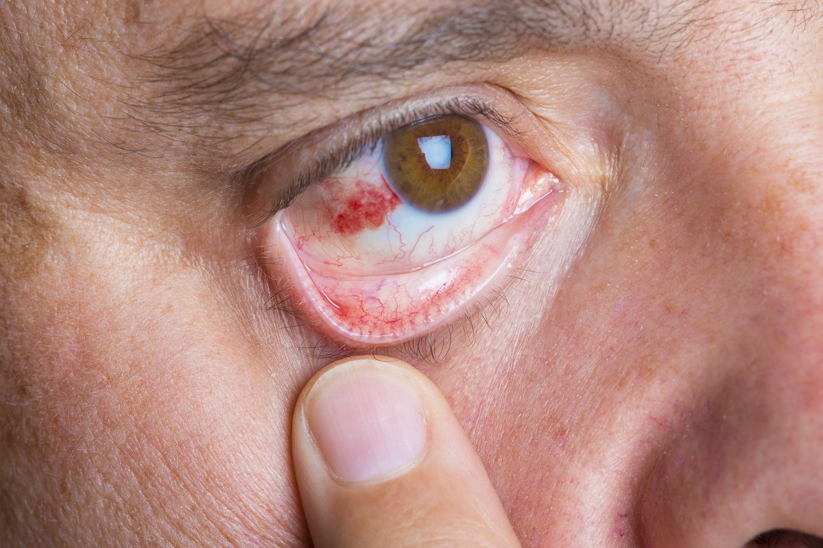 Stroke mata: apa itu, gejala, penyebab dan pengobatan_0
