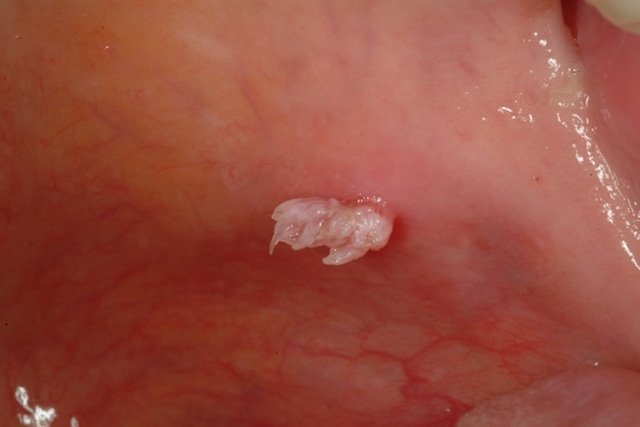 HPV di mulut: gejala, pengobatan, dan bentuk penularan_0