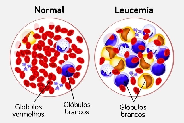 Leukemia: apa itu, jenis, gejala, penyebab dan pengobatan_0