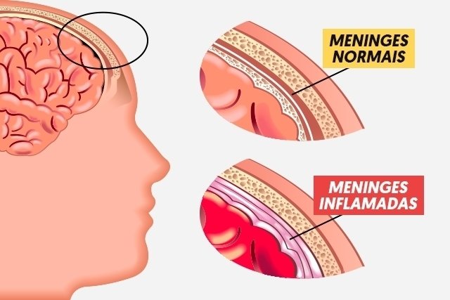 Meningitis meningokokus: apa itu, gejala, penyebab dan pengobatan_0