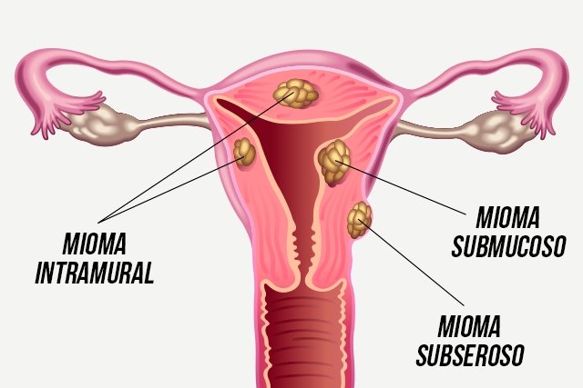 Mioma uteri: apa itu, gejala, penyebab dan pengobatan_0