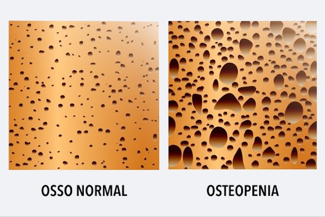 Osteopenia: apa itu, penyebab dan pengobatan_0
