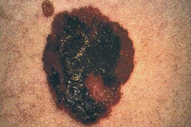 4 tanda kanker kulit (melanoma dan non-melanoma)_2