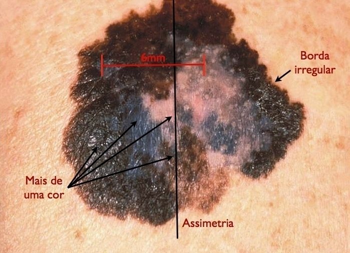 4 tanda kanker kulit (melanoma dan non-melanoma)_0