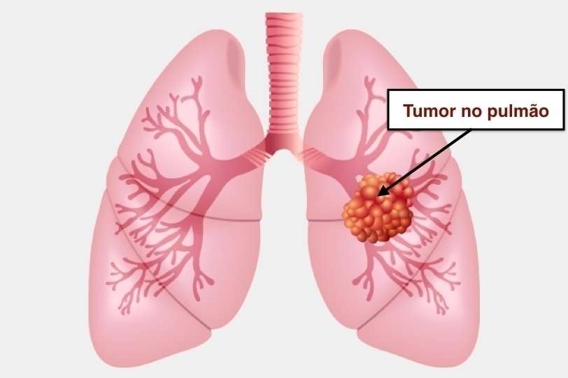Kanker paru-paru: 10 gejala dan cara memastikan diagnosis_0