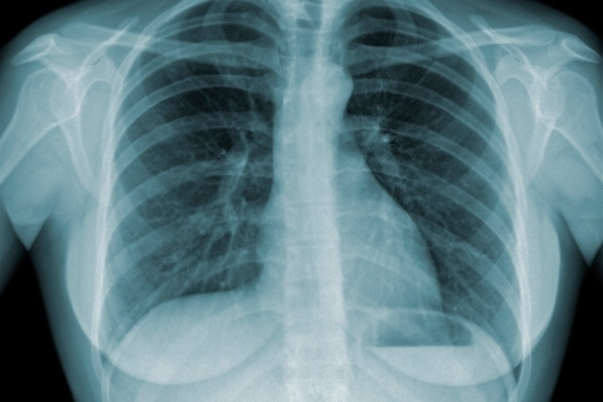6 gejala utama tuberkulosis_0