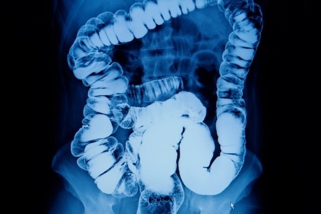 Benjolan di usus (volvulus): apa itu, gejala, penyebab dan pengobatan_0