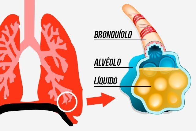 Air di paru-paru: apa itu, gejala, penyebab dan pengobatan_0