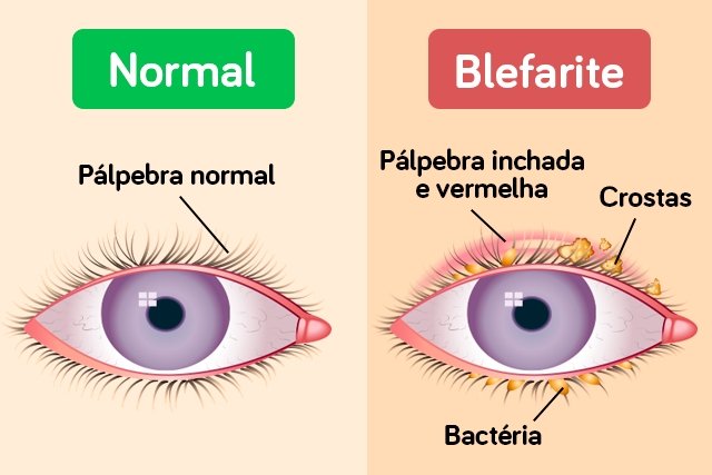 Blepharitis: apa itu, gejala, penyebab dan pengobatan_0