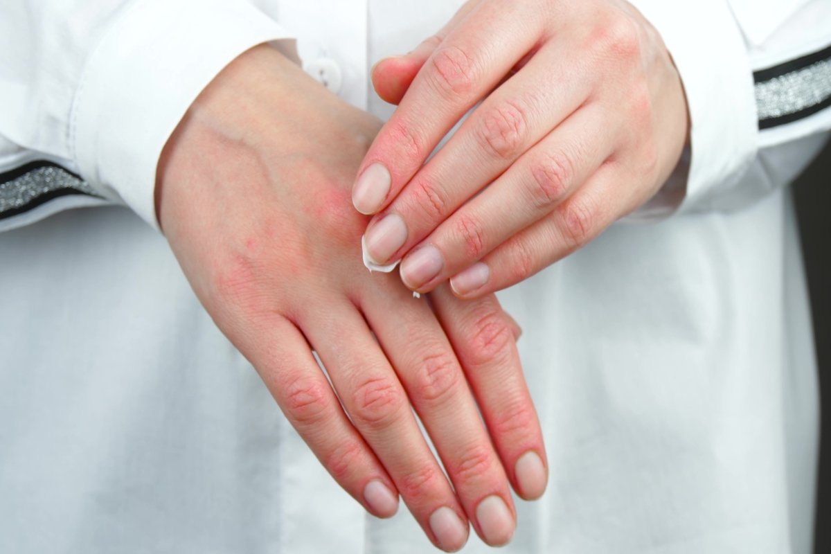 Dermatitis kontak: apa itu, gejala, penyebab dan pengobatan_0