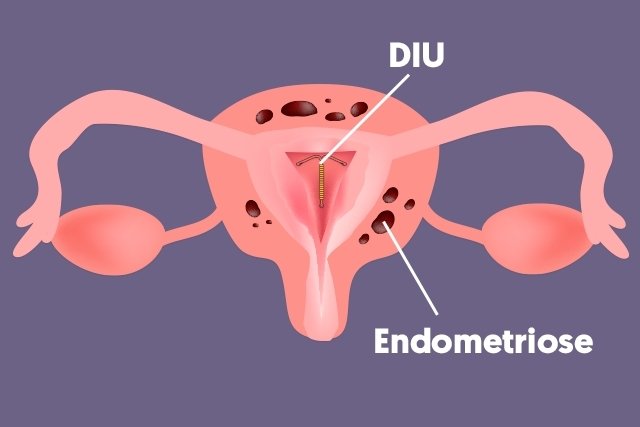 AKDR untuk endometriosis: 6 pertanyaan paling umum_0