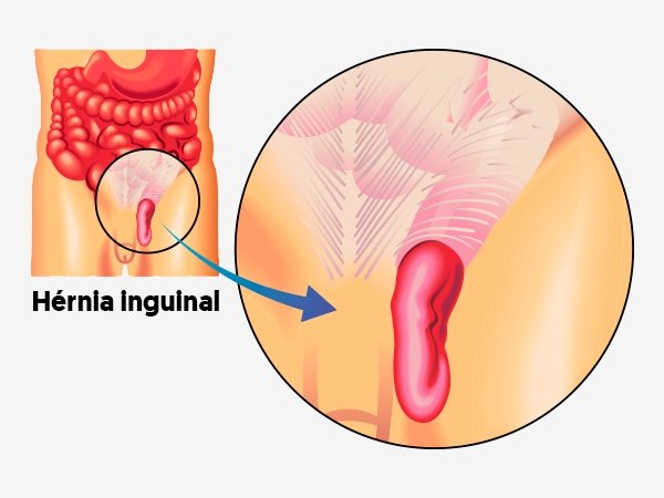 Hernia inguinalis: gejala, penyebab, operasi dan pemulihan_0