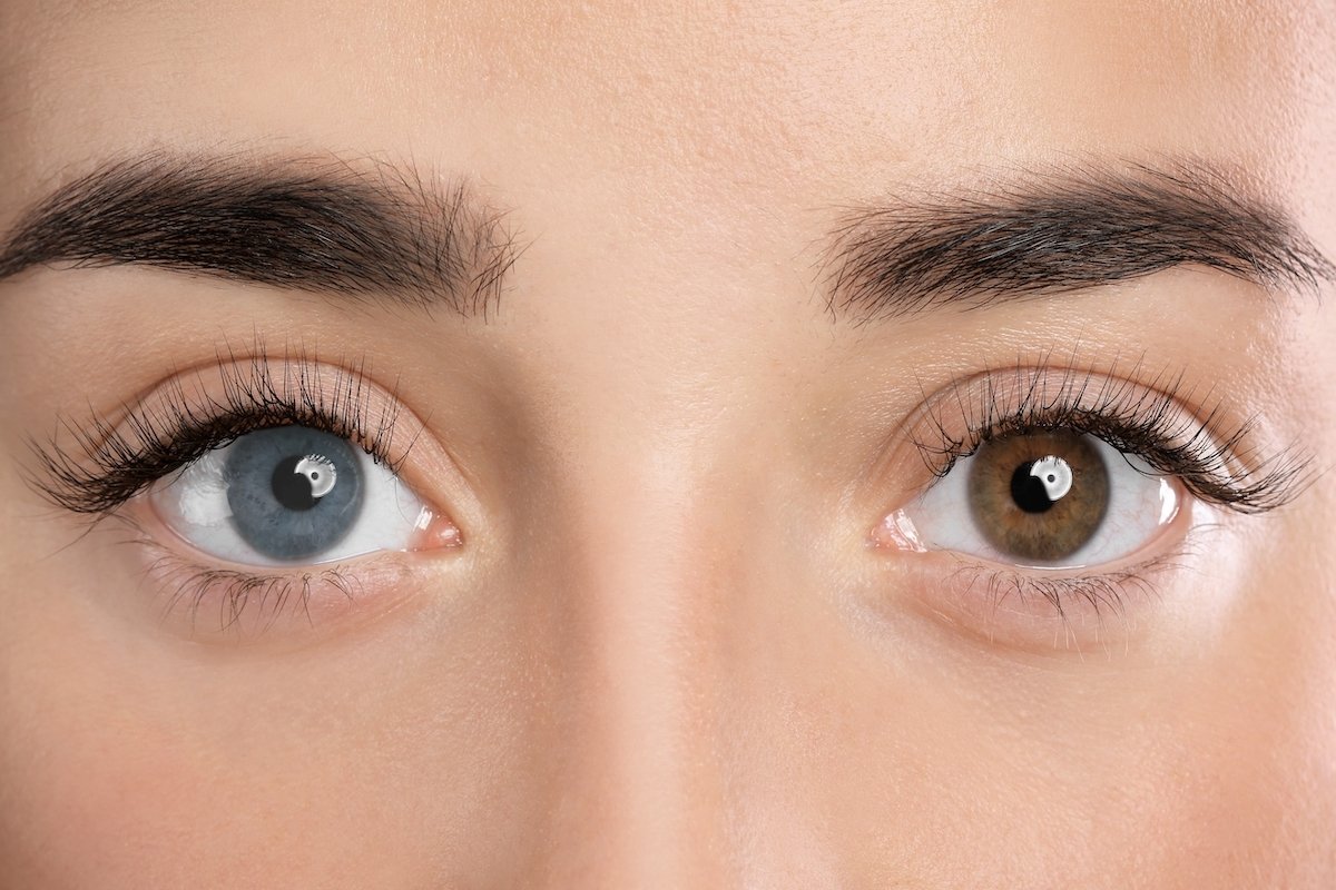 Heterochromia: apa itu, jenis, penyebab dan kapan harus ke dokter_0