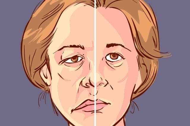 Kelumpuhan wajah: apa itu, gejala, penyebab dan pengobatan_0
