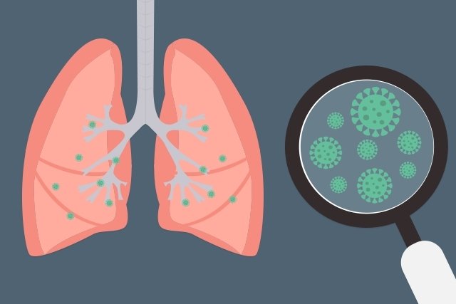 Pneumonia bakteri: apa itu, gejala, penyebab dan pengobatan_0