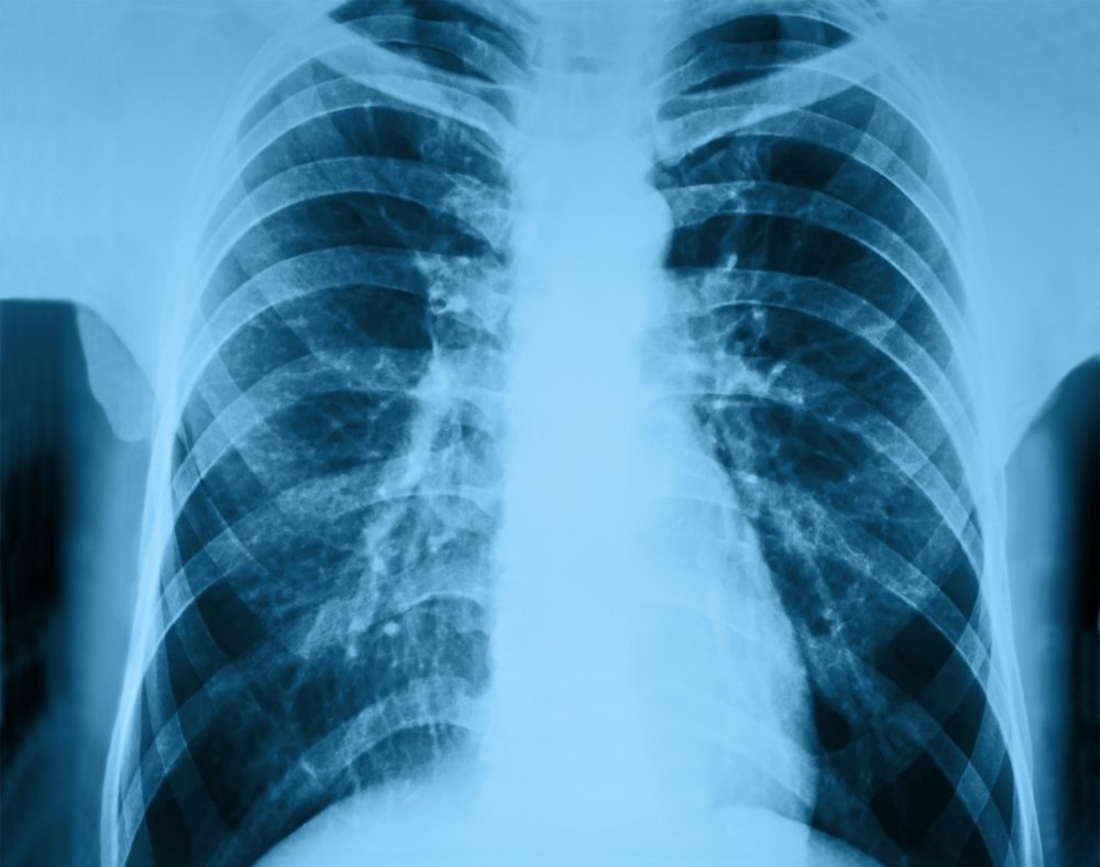 Pneumonia nosokomial: apa itu, gejala, penyebab dan pengobatan_0