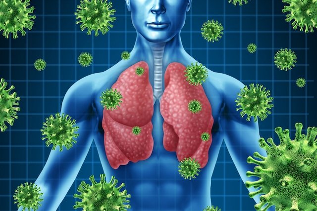 Viral pneumonia: apa itu, gejala, pengobatan dan pencegahan_0