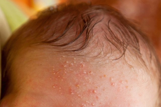 7 masalah kulit bayi yang umum dan cara merawatnya_1