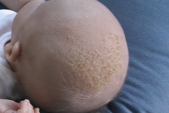 7 masalah kulit bayi yang umum dan cara merawatnya_3