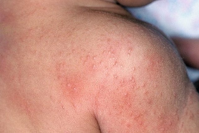 7 masalah kulit bayi yang umum dan cara merawatnya