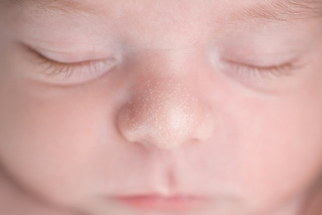 7 masalah kulit bayi yang umum dan cara merawatnya