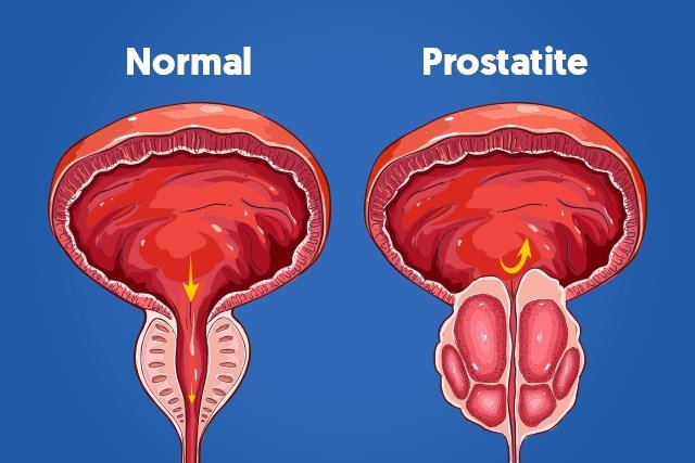 Prostatitis: apa itu, gejala, penyebab dan pengobatan_0