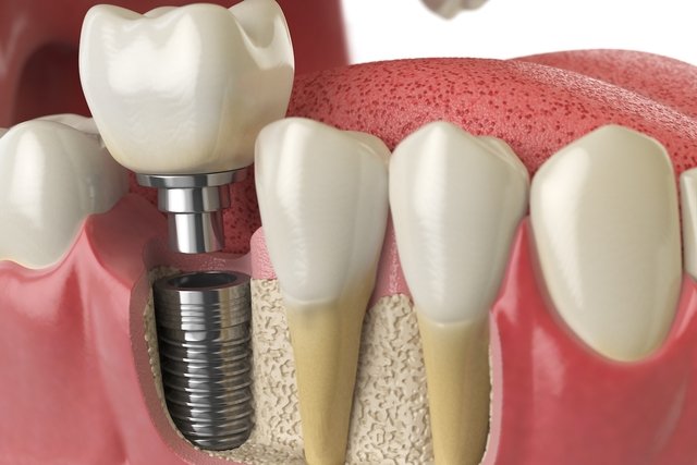 Prostesis gigi: apa itu, jenis, kapan digunakan dan dirawat_1
