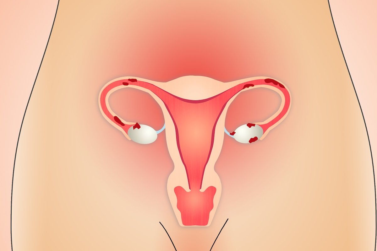 Apakah penderita endometriosis bisa hamil?_0
