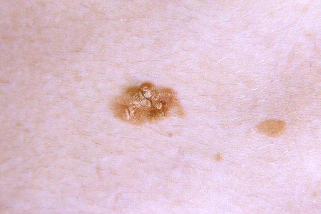 5 jenis kanker kulit: bagaimana mengidentifikasi dan apa yang harus dilakukan_1