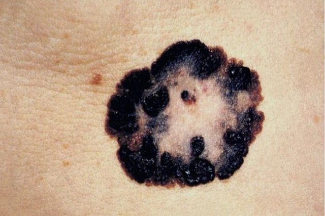 5 jenis kanker kulit: bagaimana mengidentifikasi dan apa yang harus dilakukan_3
