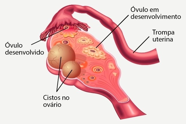 Perawatan ovarium polikistik: pengobatan, pembedahan, dan pilihan alami_0