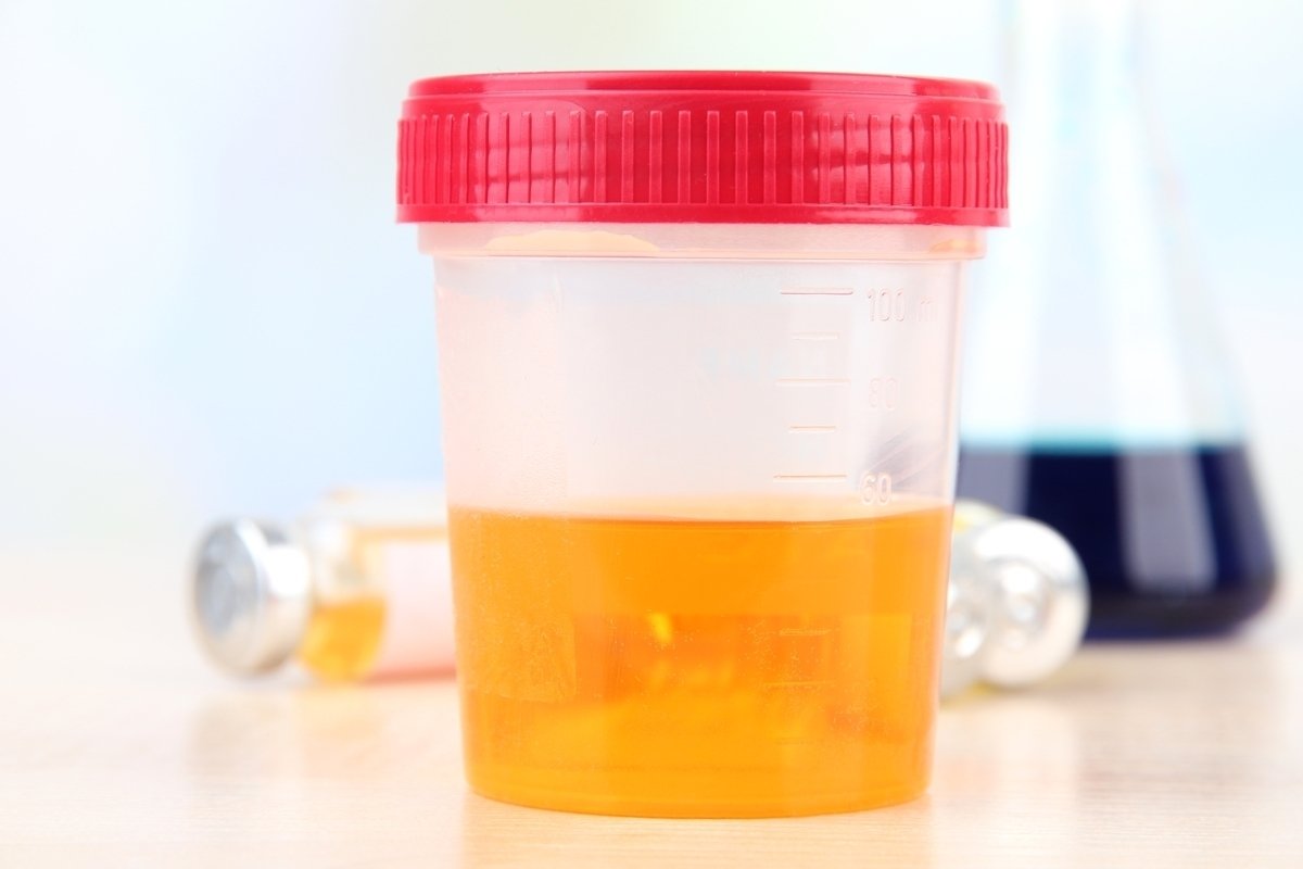 Urobilinogen dalam urin: apa itu dan apa yang harus dilakukan_0
