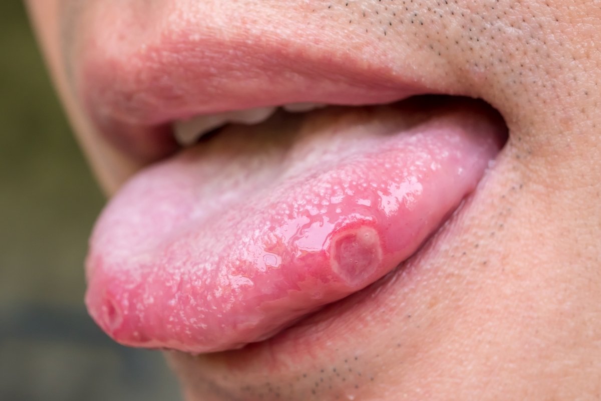 Sariawan di lidah: gejala, penyebab dan pengobatan_0