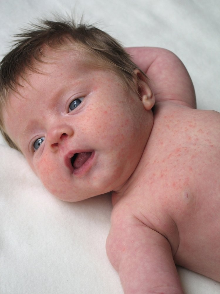 Alergi kulit bayi: penyebab, gejala dan apa yang harus dilakukan_0