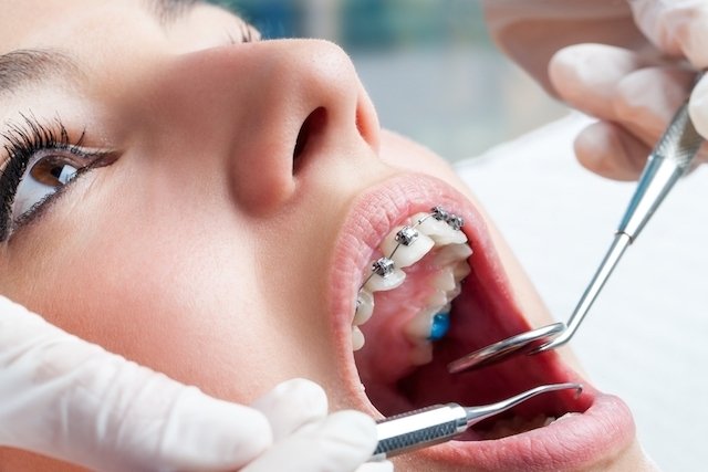 Maloklusi gigi: apa itu, gejala dan pengobatan_0