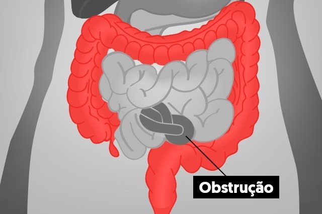 Obstruksi usus: apa itu, gejala, penyebab dan pengobatan_0